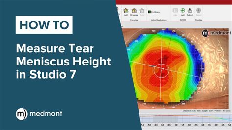 tear breakup time test|tear meniscus height normal value.